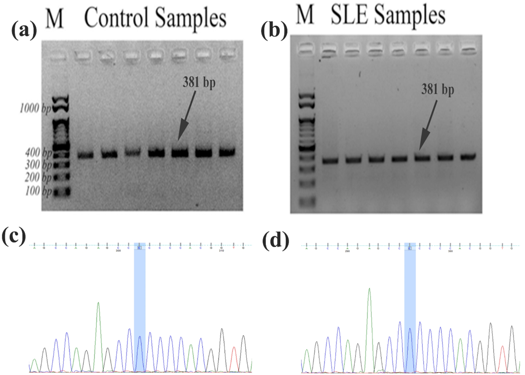 Investigation of Association of TYK2-P1104A Variant in Systemic Lupus Erythematosus Patients With or Without Tuberculosis