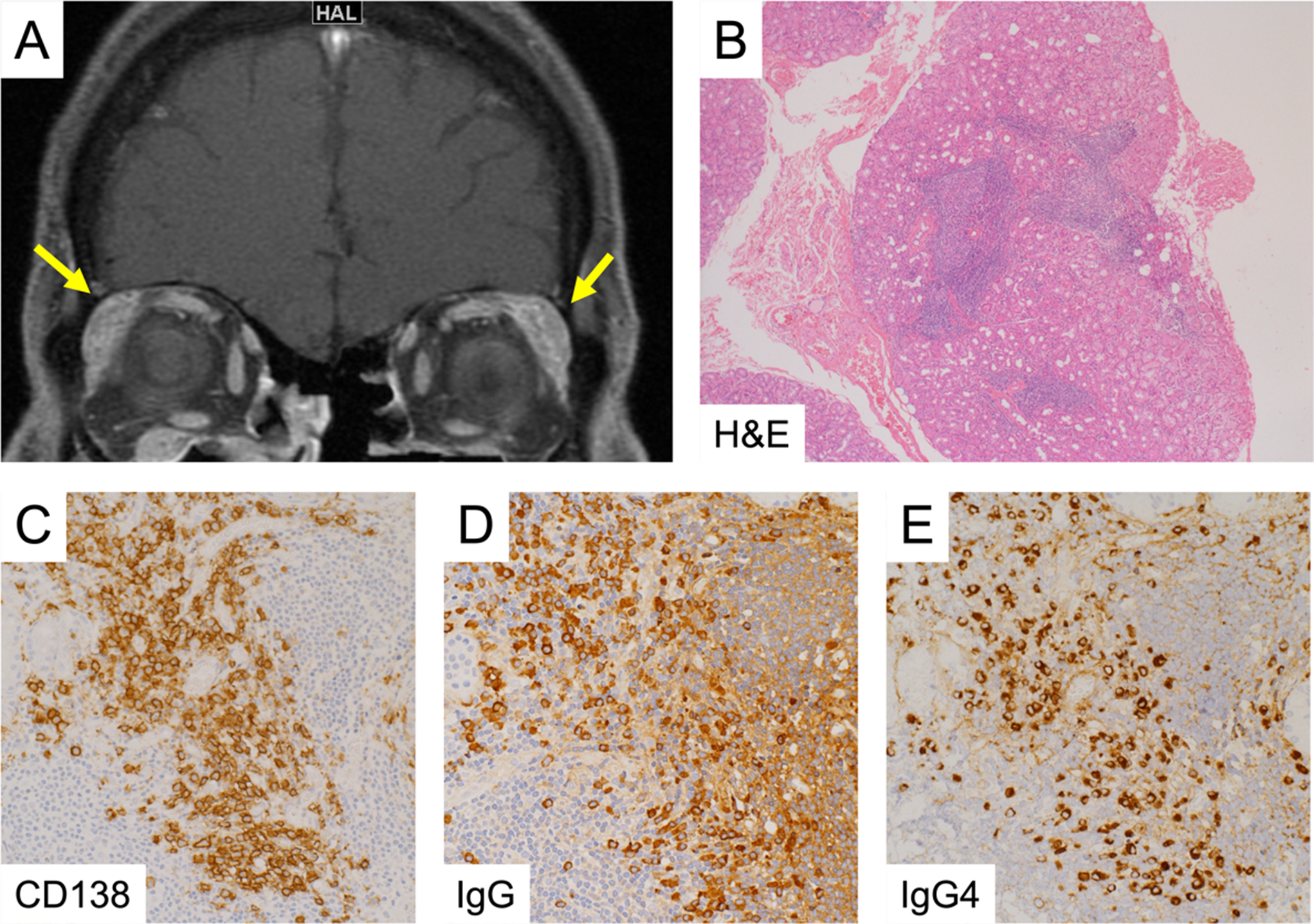 Successful rituximab treatment in IgG4-related coronary periarteritis: a case-based review