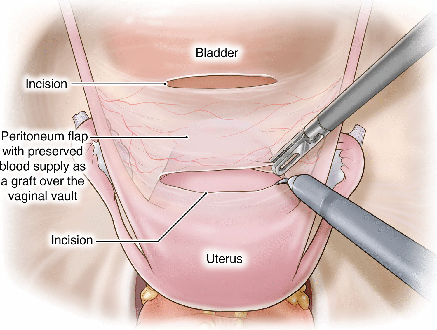 Intrafascial Colpotomy, Edge-to-Edge Closure, and Peritoneal Graft Technique for Minimizing Mesh Erosion in Concurrent Robotic Hysterectomy and Sacrocolpopexy