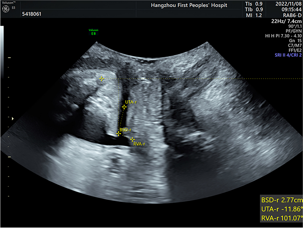 Epidural Anesthesia and Pelvic Floor Outcomes in Primiparas: A Retrospective Transperineal Ultrasound Study