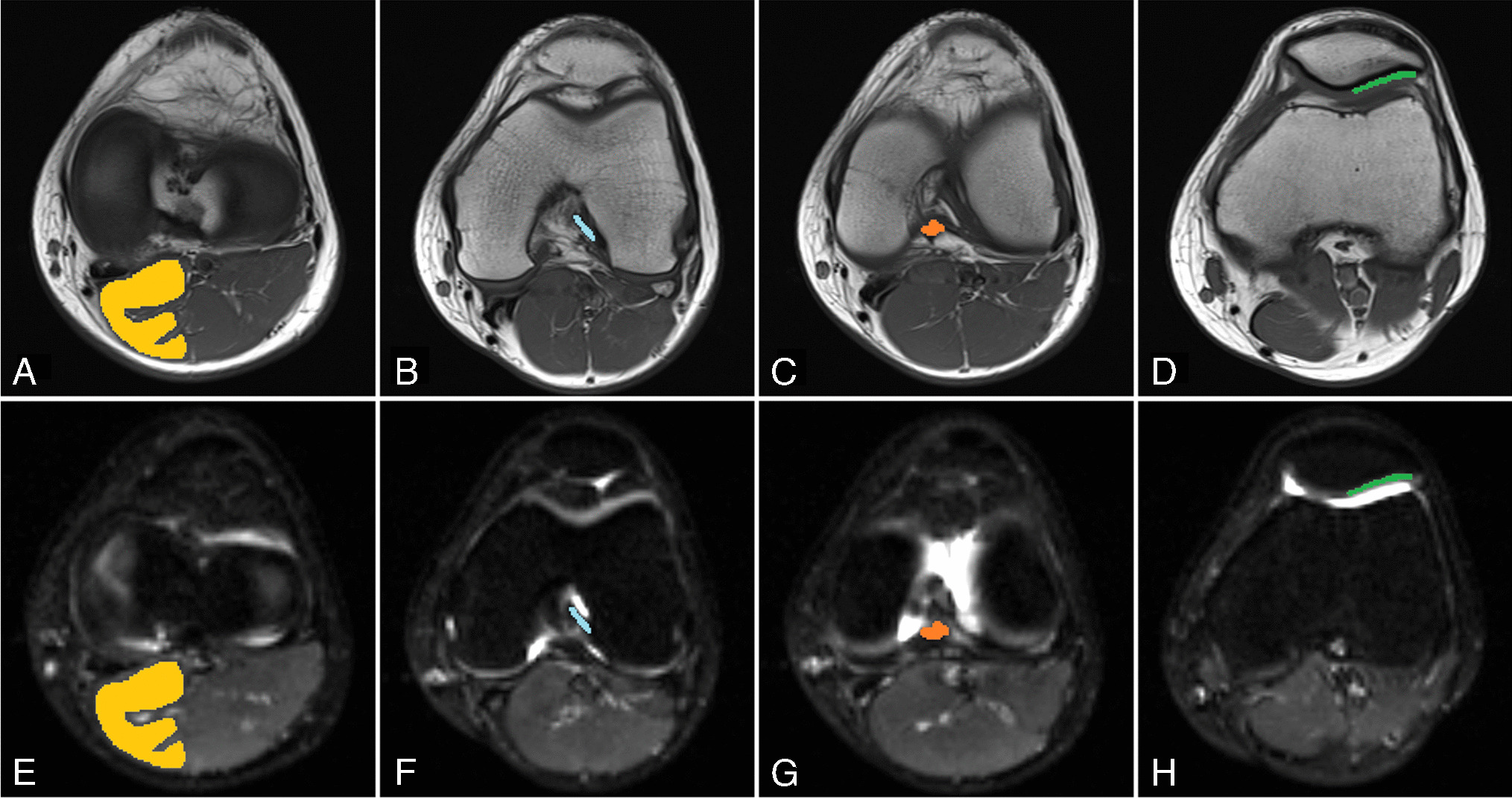 Simultaneous multi-slice technique for reducing acquisition times in diffusion tensor imaging of the knee: a feasibility study