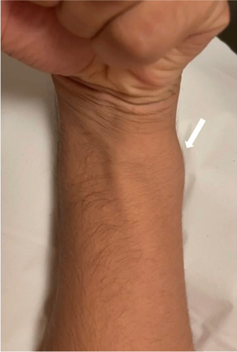 A novel case of ulnar nerve compression neuropathy with co-existing accessory flexor carpi ulnaris and accessory abductor digiti minimi