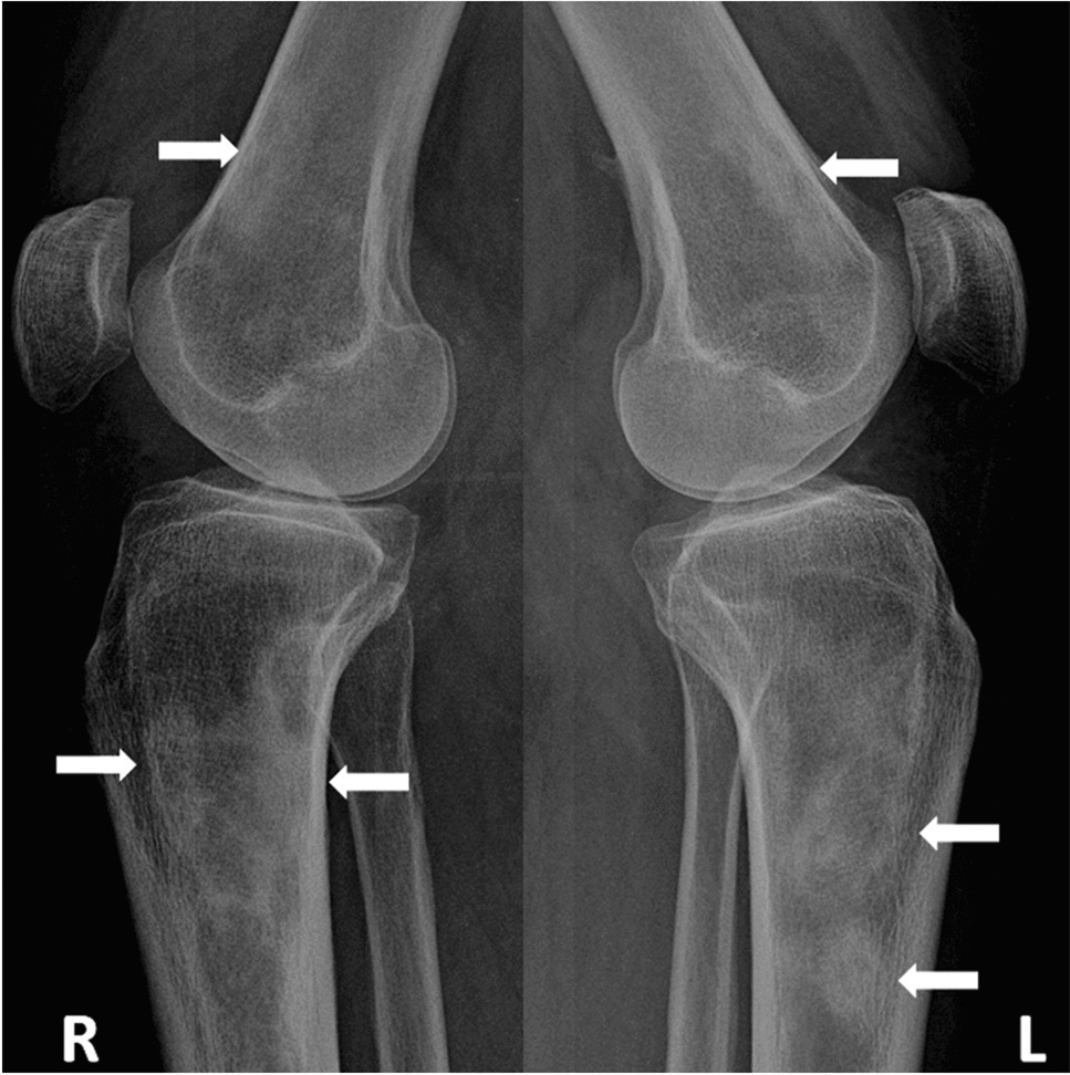 Erdheim-Chester disease and nuclear medicine imaging. A case report and brief review