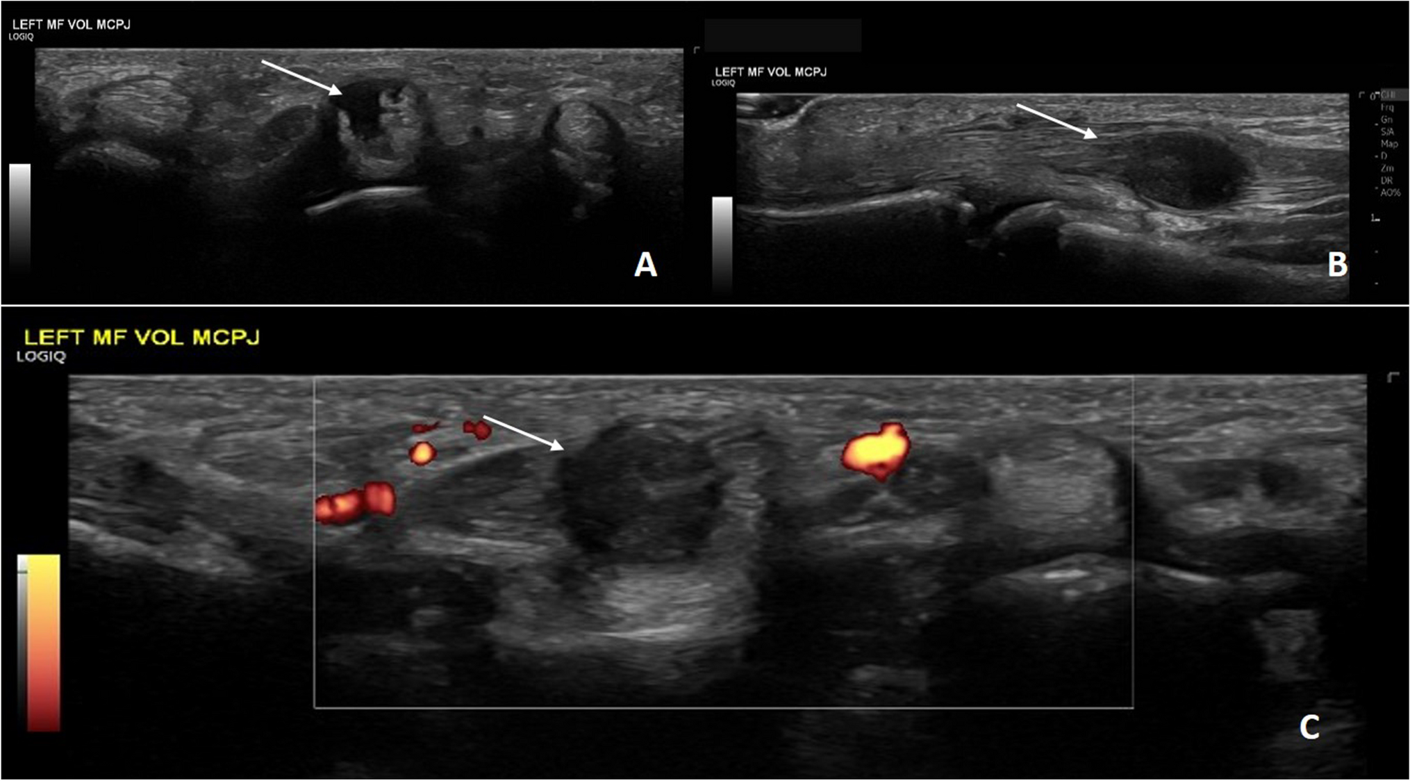 An unusual case of nodular fasciitis presenting as an intra-tendinous mass