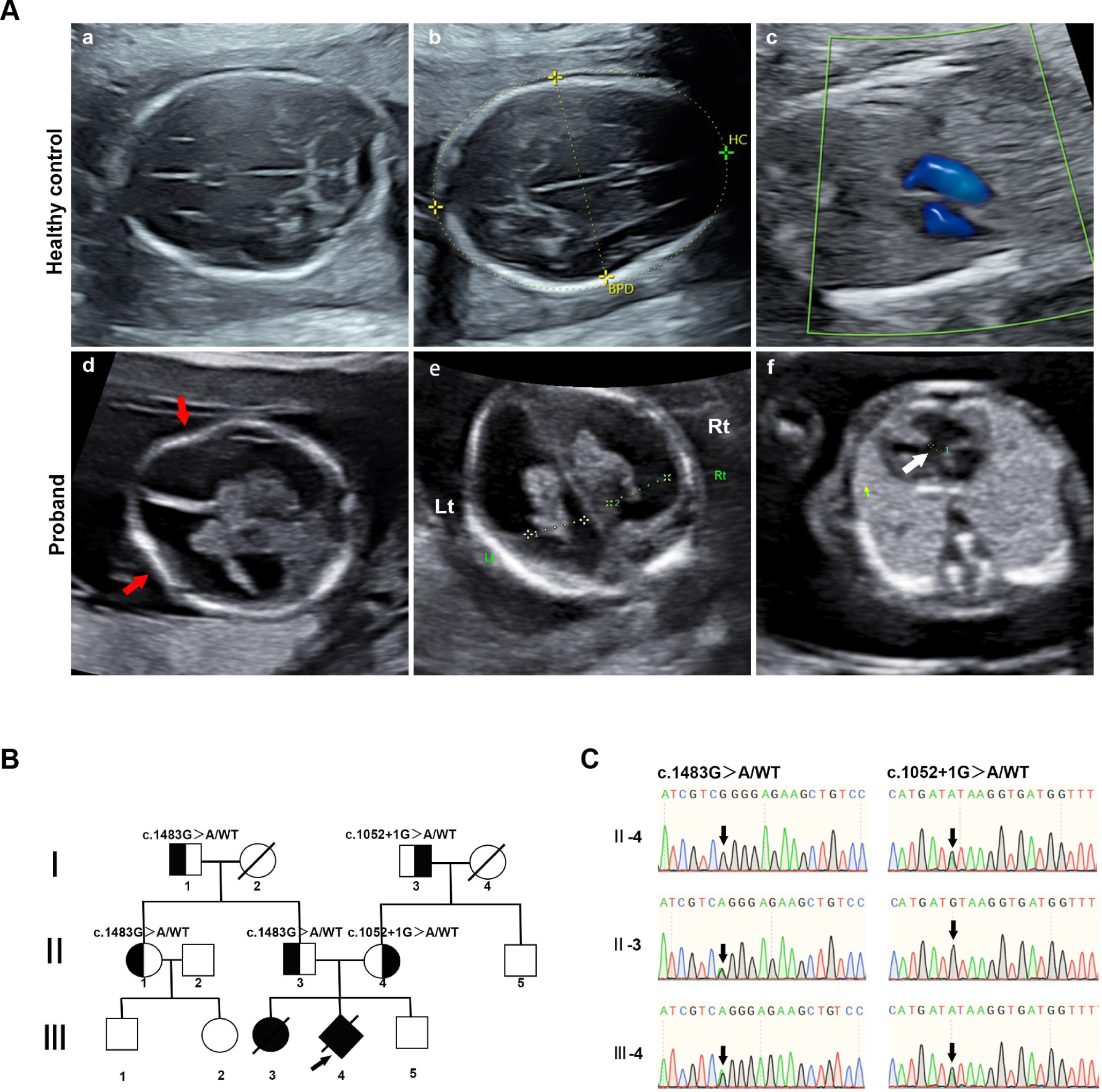 Reclassifying a Novel POMT1 Variant by Integrating Functional Analysis and Bioinformatics: Implications for Preimplantation Genetic Testing