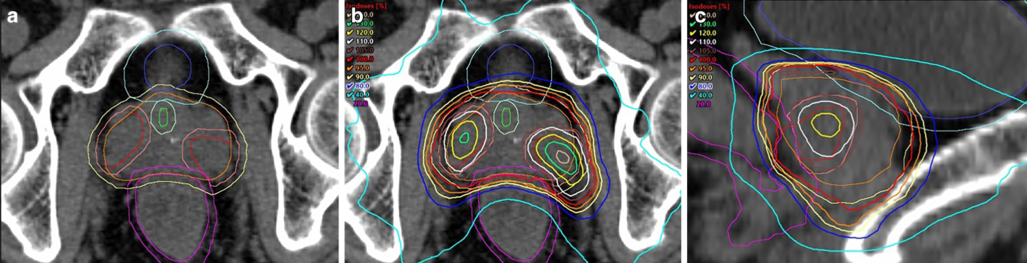 Toxicity profile and clinical outcomes of stereotactic body radiotherapy with a focal boost without fiducials or perirectal hydrogel spacer for localized prostate cancer