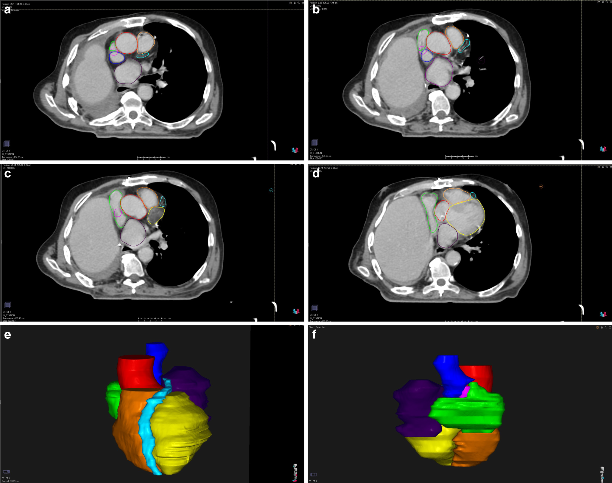 Evaluating the impact of cardiac substructure dosimetric parameters on survival in lung cancer patients undergoing postoperative radiotherapy
