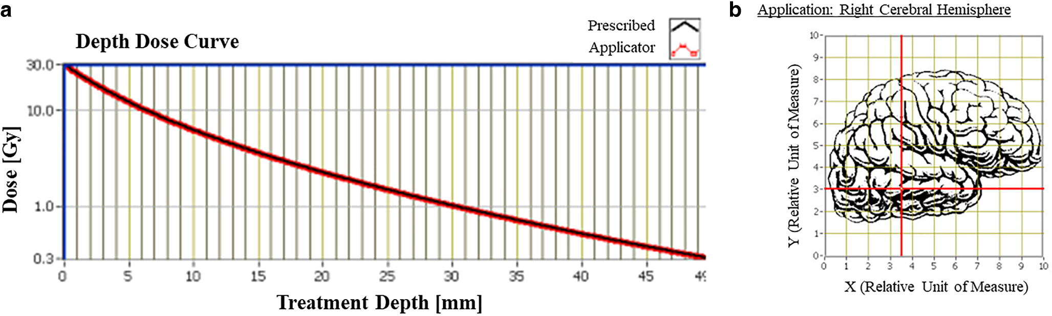 Intraoperative radiation therapy for brain metastasis in a pregnant patient: a case report
