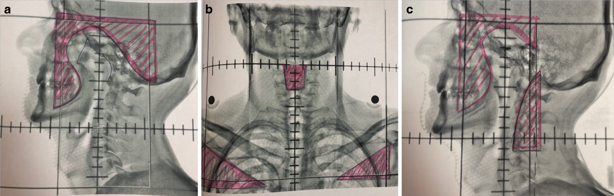 Analysis of patients with parotid recurrence after parotid-sparing IMRT for nasopharyngeal carcinoma: case series and review of the literature