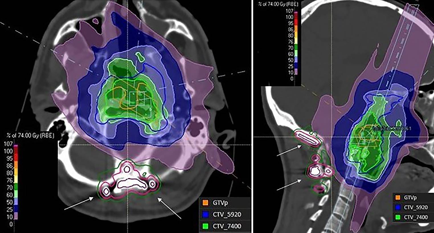 Robust IMPT and follow-up toxicity in skull base chordoma and chondrosarcoma—a single-institution clinical experience