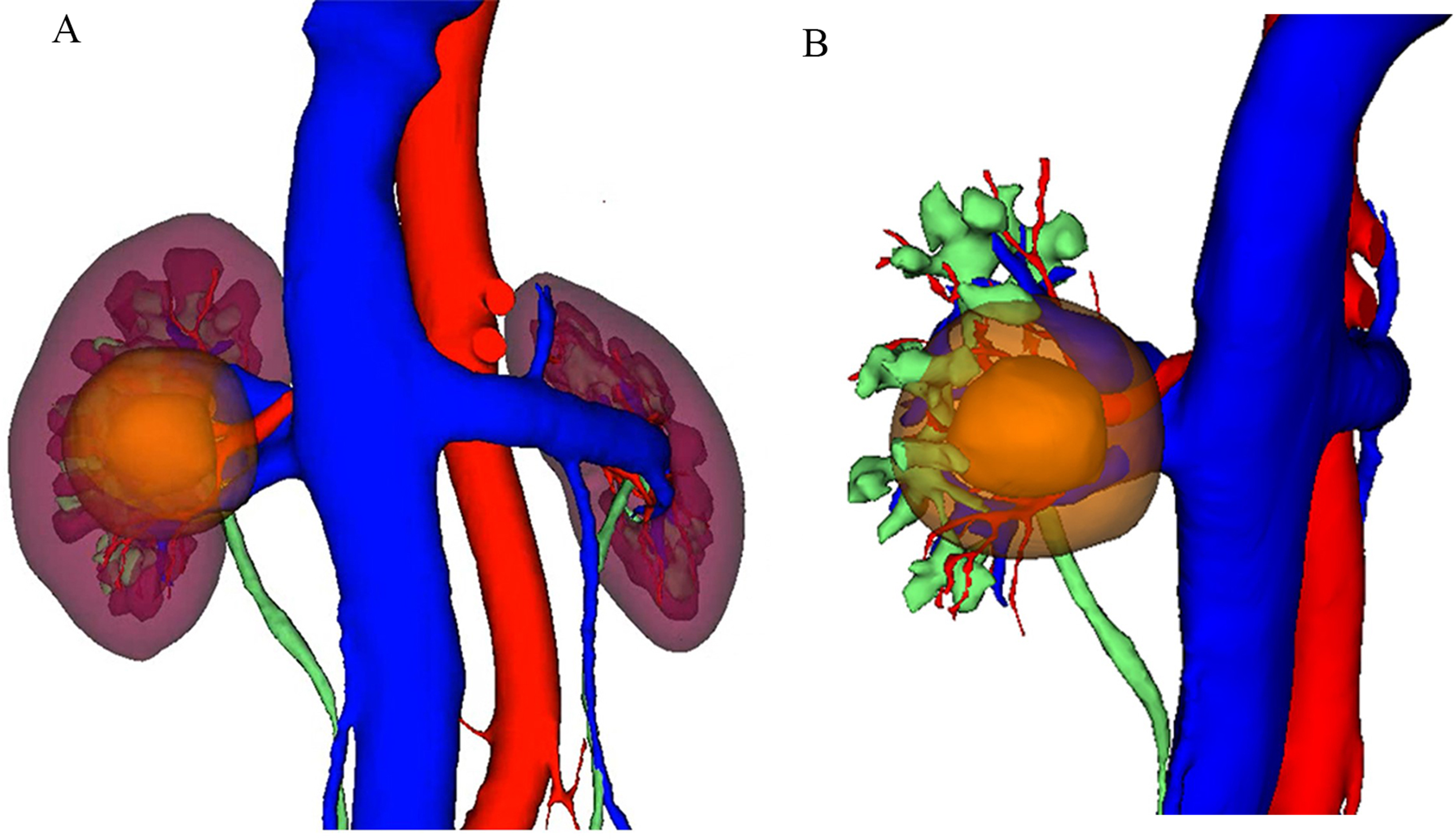 A novel preoperative evaluation technique for partial nephrectomy: three-dimensional extended renal tumor plane