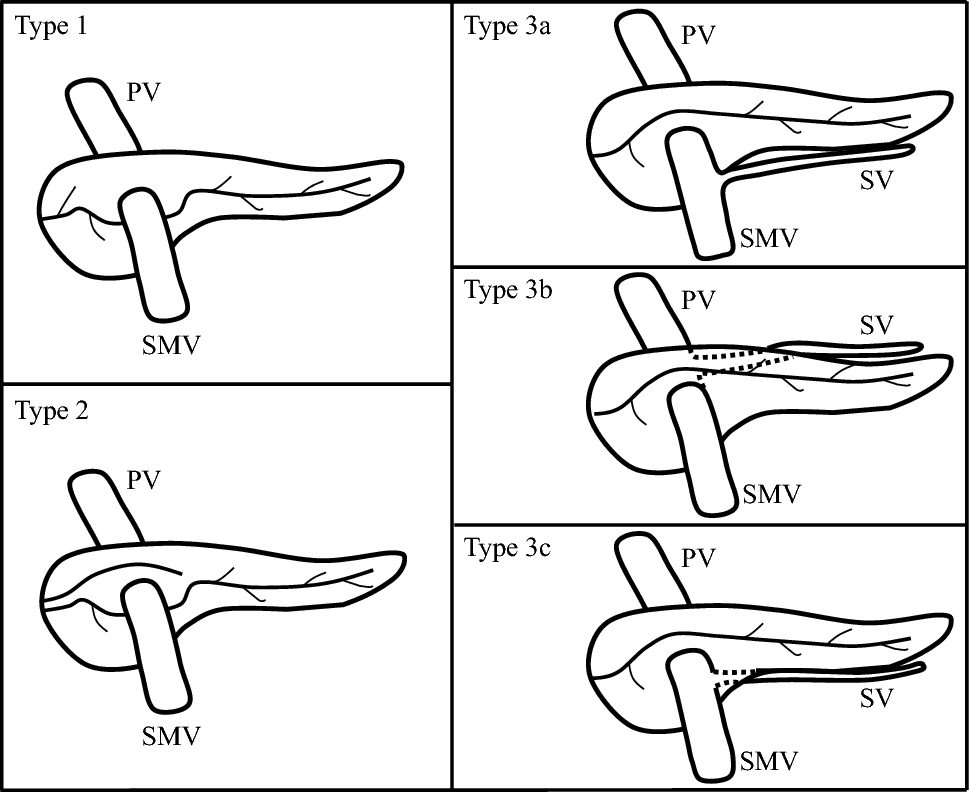 Robotic pancreaticoduodenectomy for portal annular pancreas: how to do it
