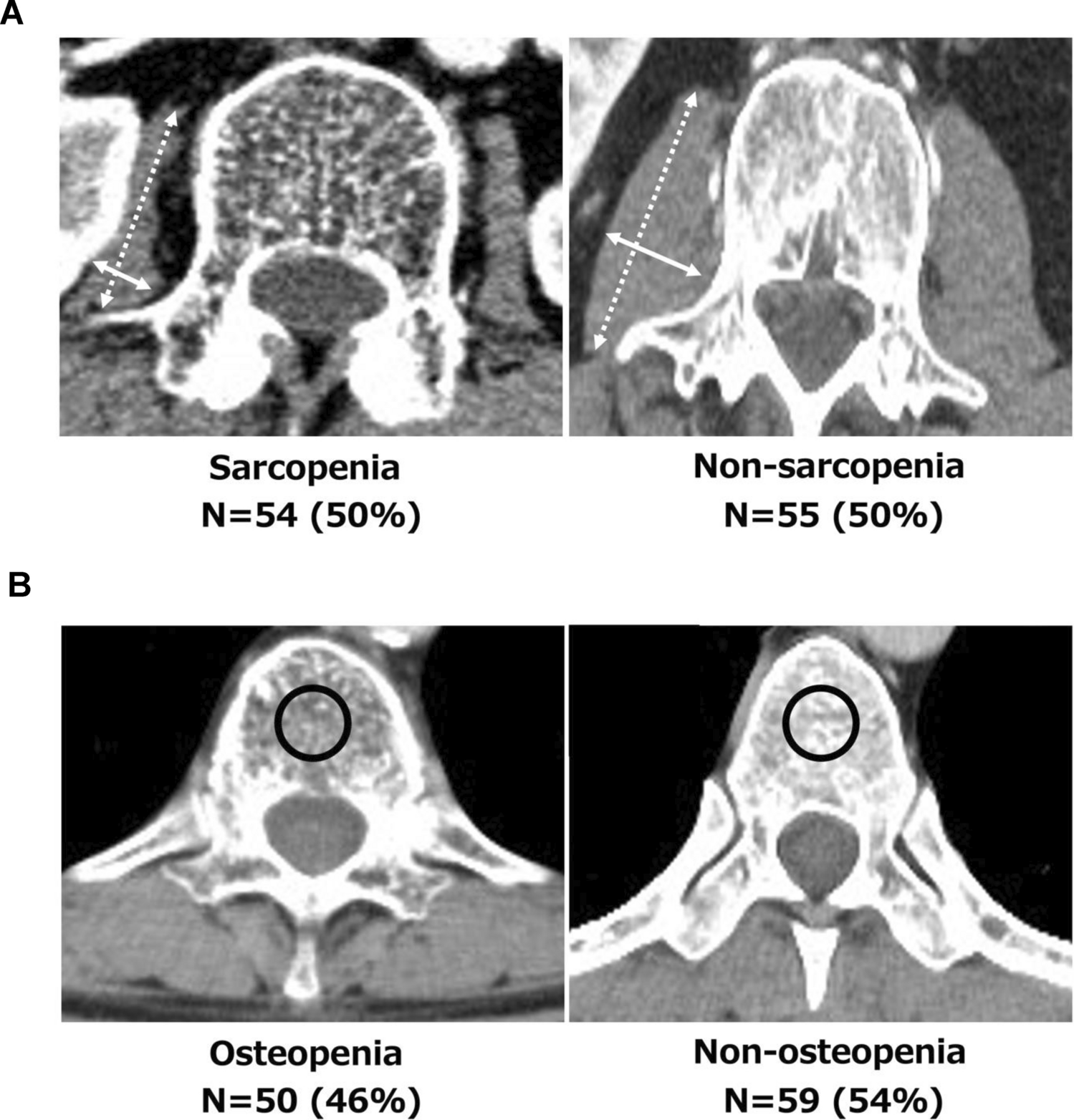 Prognostic impact of osteosarcopenia on postoperative outcomes in patients with biliary tract cancer