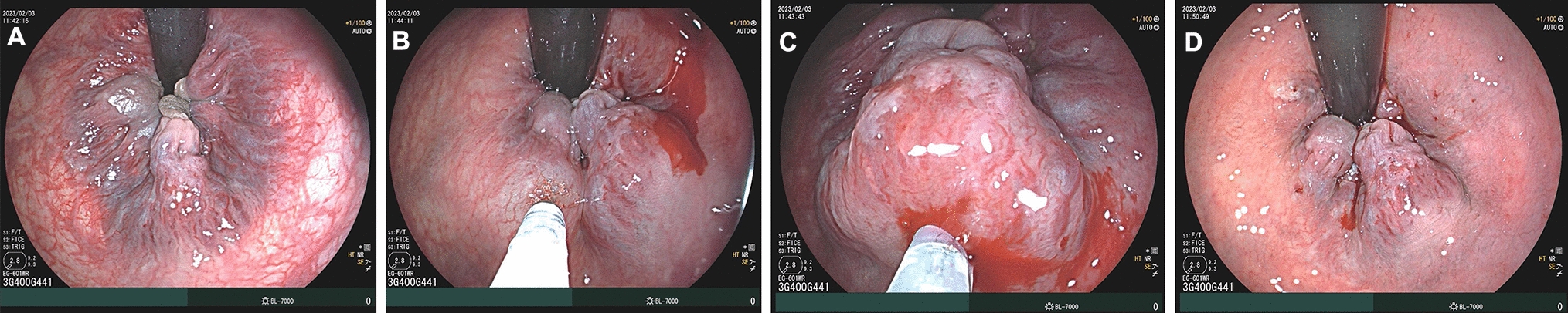 Rubber band ligation or shaobei injection for the endoscopic treatment of symptomatic hemorrhoids? A retrospective study