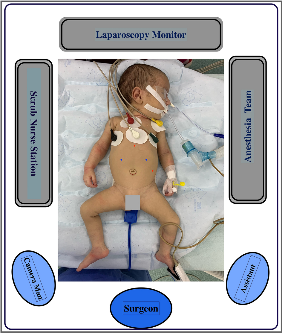 Eversion cruroplasty and collar overwrap: a novel hybrid approach for refractory gastroesophageal reflux disease in children, with assessment of mid-term outcomes