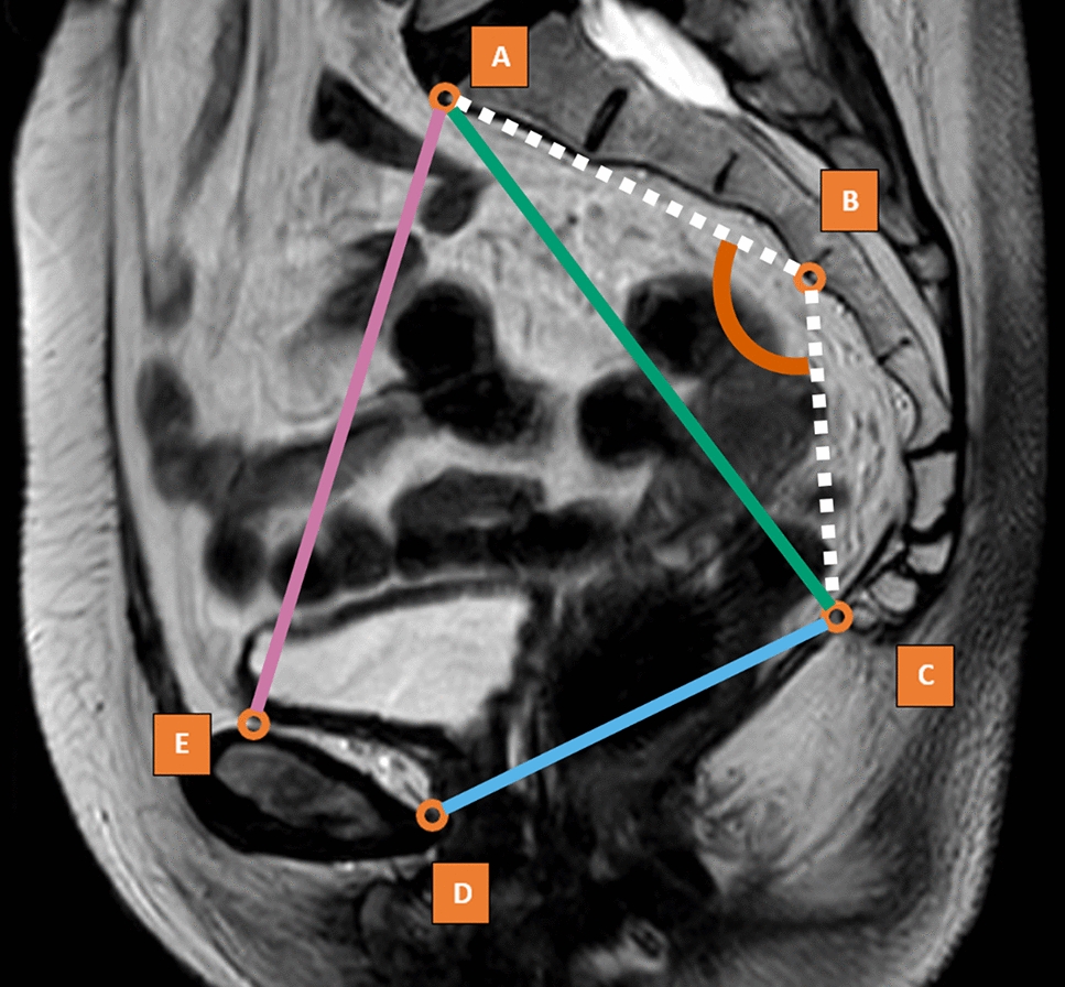 Deep learning-based pelvimetry in pelvic MRI volumes for pre-operative difficulty assessment of total mesorectal excision