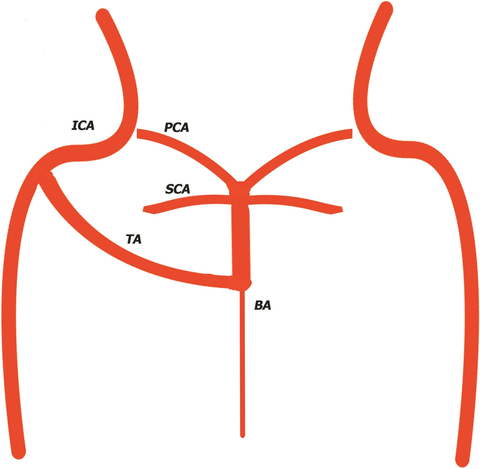 Trigeminal artery anatomical aspects