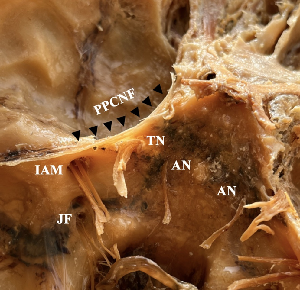 The posterior petroclinoid fold and petroclival ligament ossification patterns