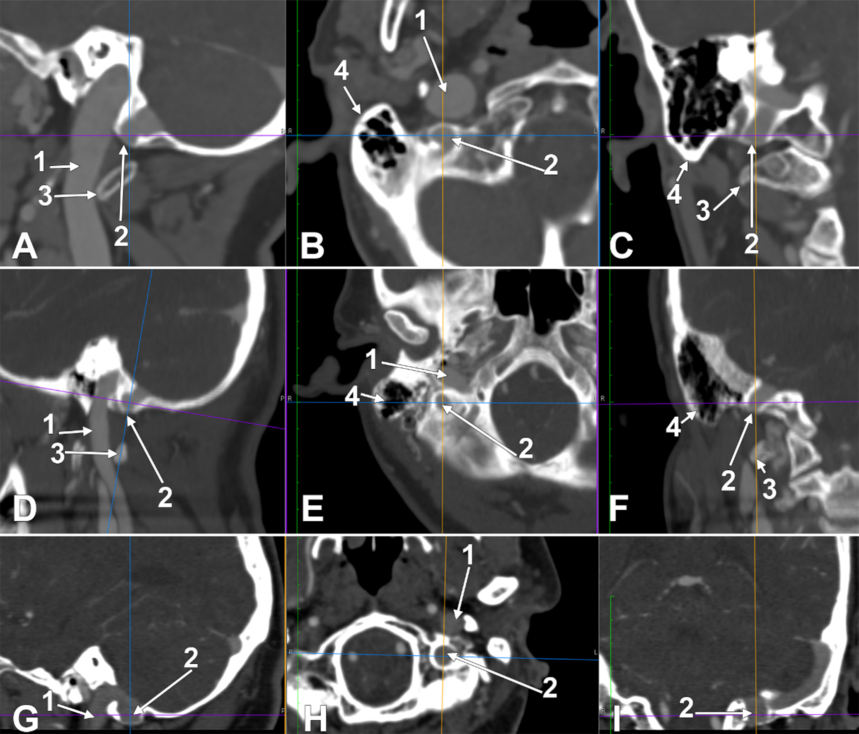 A new anatomical finding: the paramastoid diverticulum of the sigmoid sinus