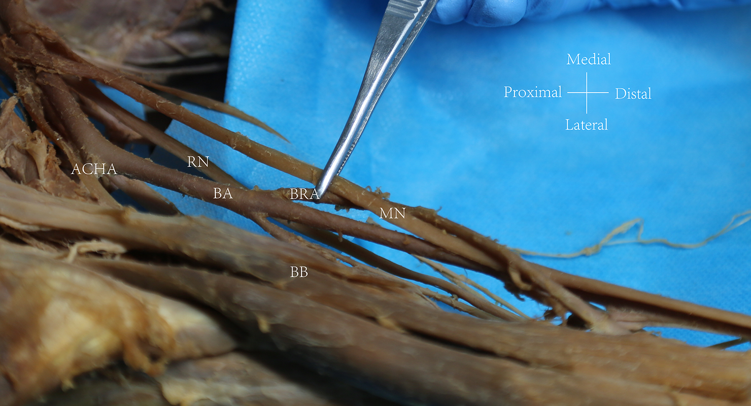 The right brachioradial artery with the radial recurrent artery absence: a cadaveric case report