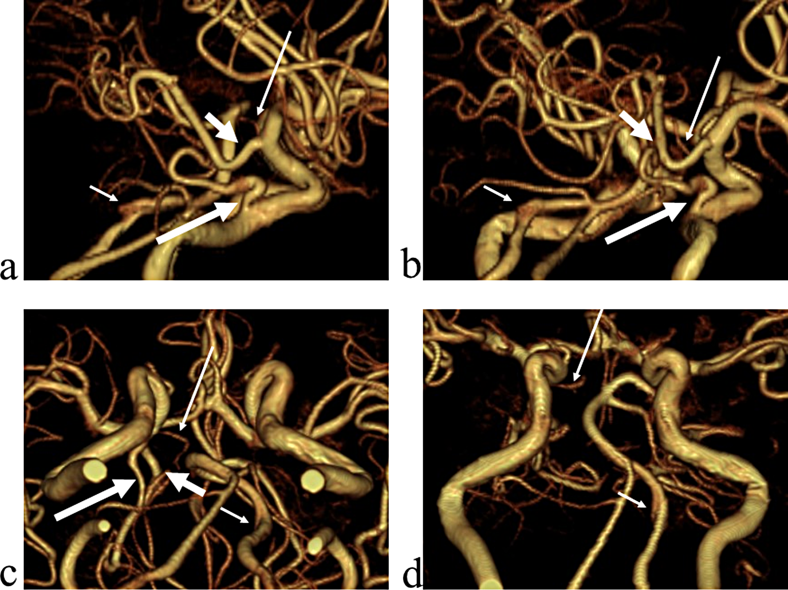 Replaced right posterior cerebral artery associated with ipsilateral superior cerebellar artery type persistent trigeminal artery variant diagnosed by magnetic resonance angiography