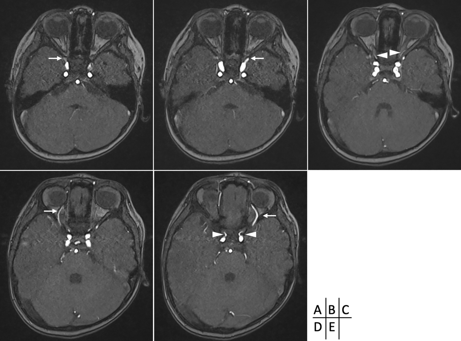 Regression of bilateral persistent primitive ophthalmic artery: a case report