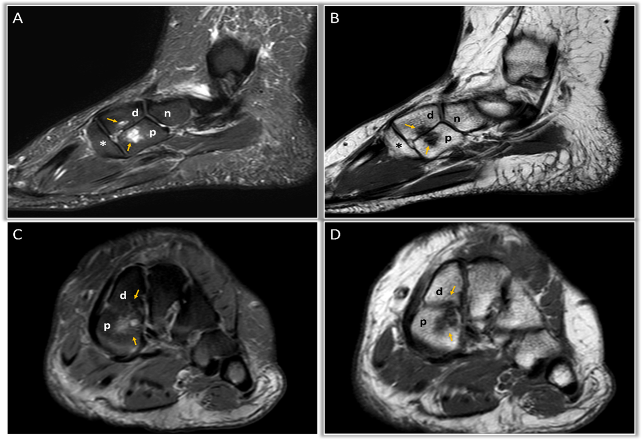 A bipartite medial cuneiform bone: a rare variant with symptomatic presentation and the classic “E-sign”