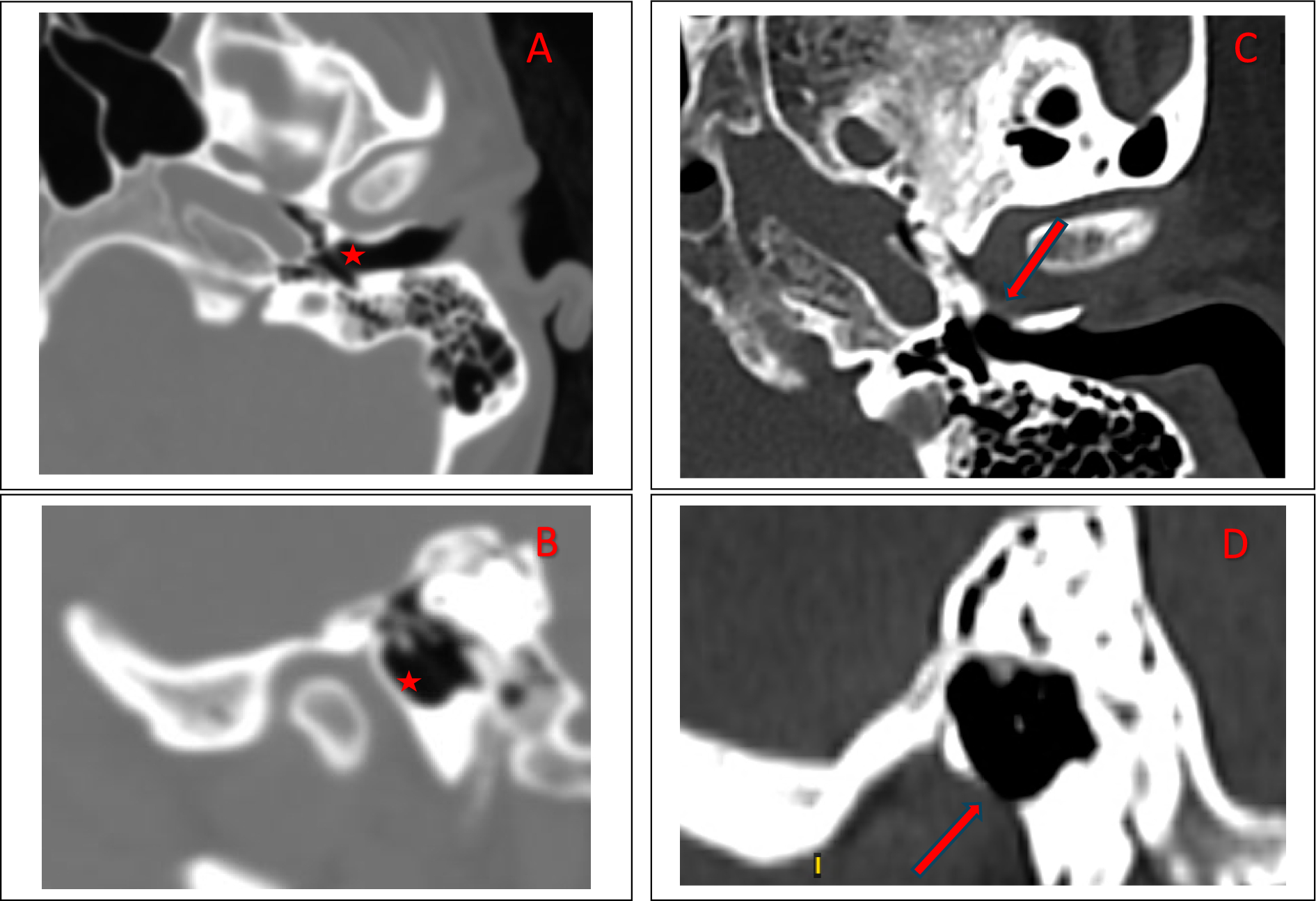 Foramen tympanicum: tomographic study of a large cohort of Europeans
