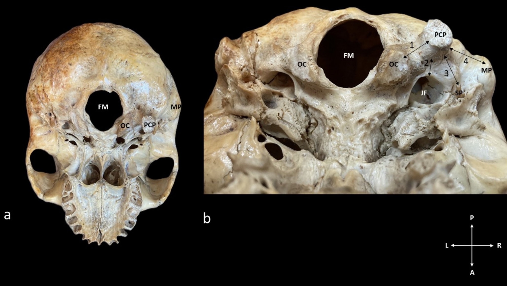 A case report of rare variant: well-developed paracondylar process