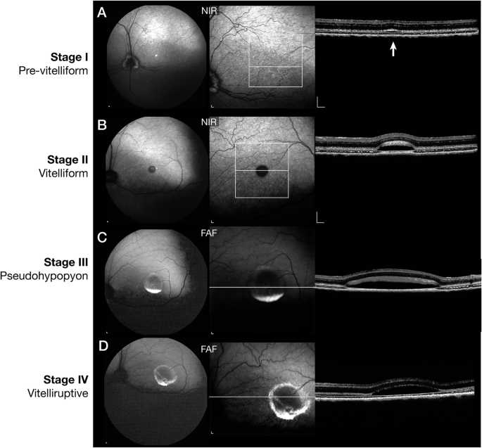 Canine Best disease as a translational model