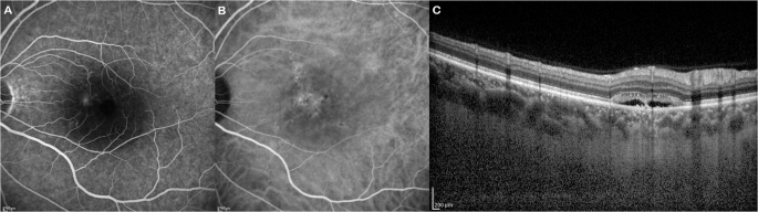 Long-term effect of photodynamic therapy on choroidal vascularity index versus choroidal thickness as biomarkers for chronic central serous chorioretinopathy