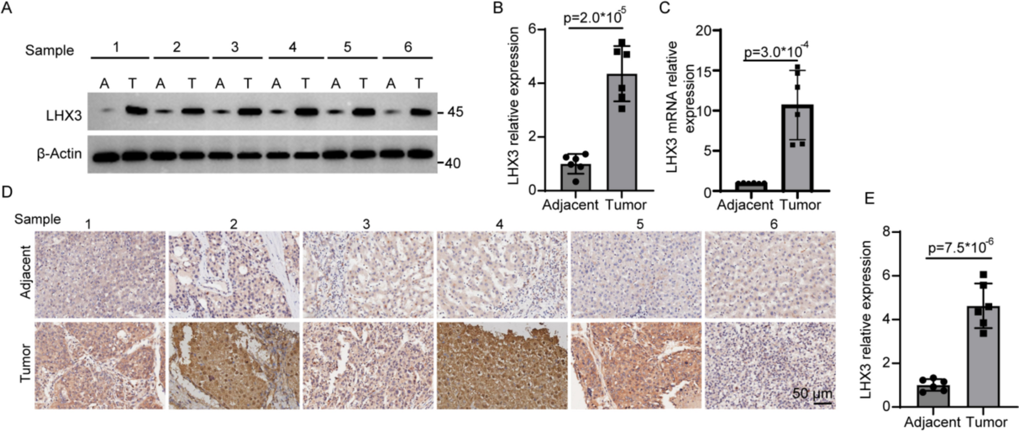 LHX3 promotes EMT in hepatoma cell through β-catenin/TCF4 pathway