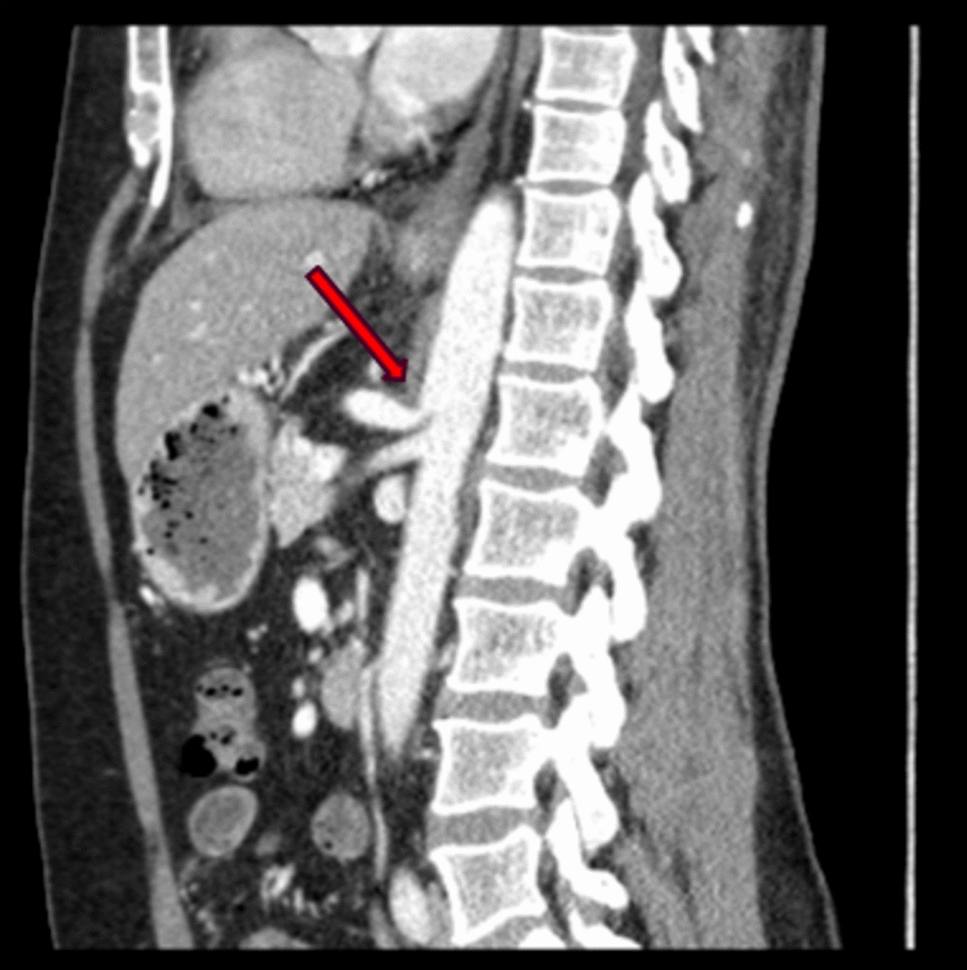 Robotic median arcuate ligament release prior to pancreatoduodenectomy