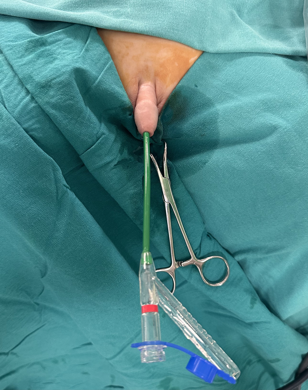 Comparison of flexible and navigable suction ureteral access sheath with conventional ureteral access sheath for pediatric retrograde intrarenal surgery: a single-center propensity-matched analysis