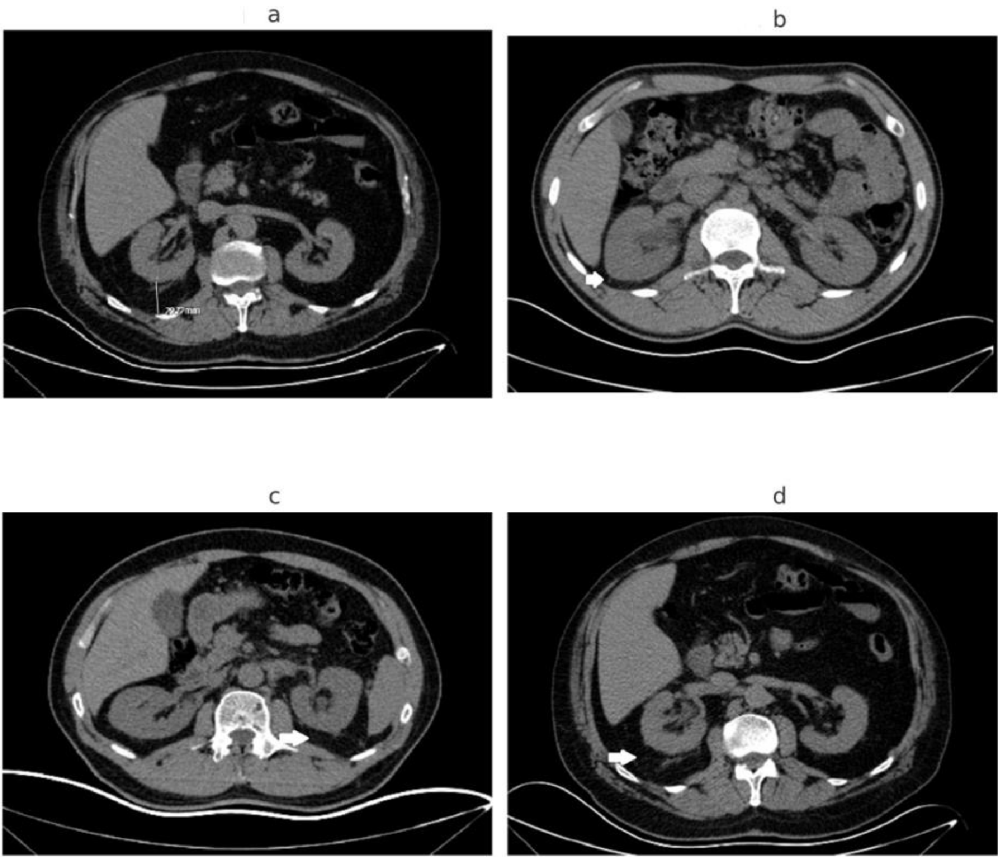 The impact of Mayo Adhesion probability score on the success of extracorporeal shock wave lithotripsy for kidney stones