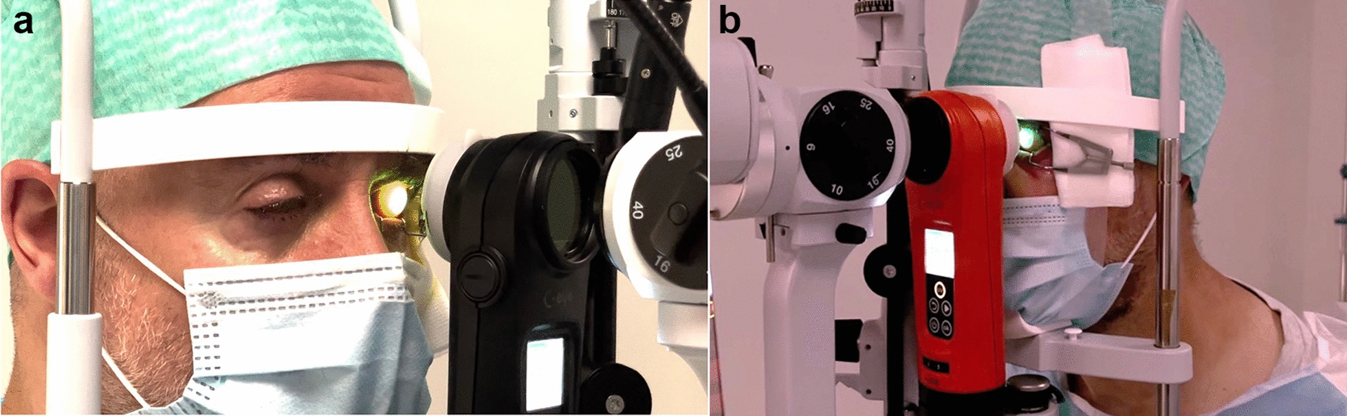 Same-session dual chromophore riboflavin/UV-A and rose bengal/green light PACK-CXL in Acanthamoeba keratitis: a case report