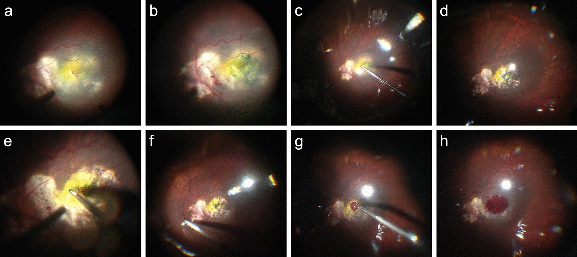Comparison of the inverted internal limiting membrane flap technique without versus with an autologous blood clot for treating macular hole-associated retinal detachment
