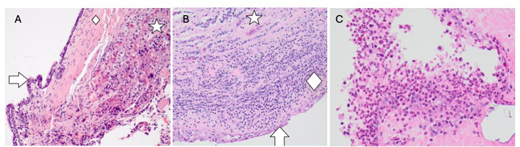 Inflammation of adenohypophysis is commonly associated with headache in surgically managed Rathke’s cleft cysts