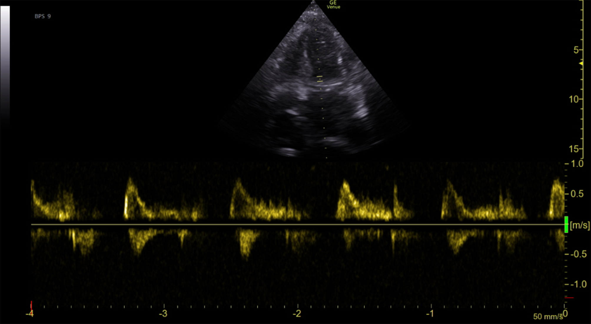 Myeloid sarcoma of the heart—A clinicopathological correlation