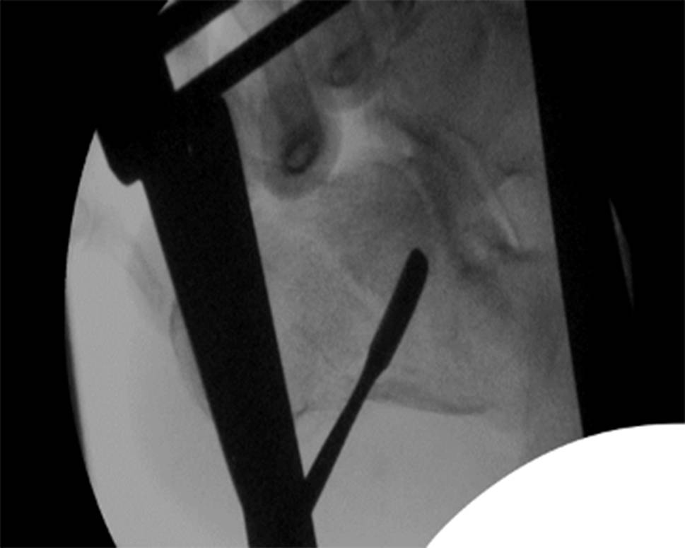 Mid-term results of intra-articular calcaneal fractures treated with minimally invasive two-point distractor