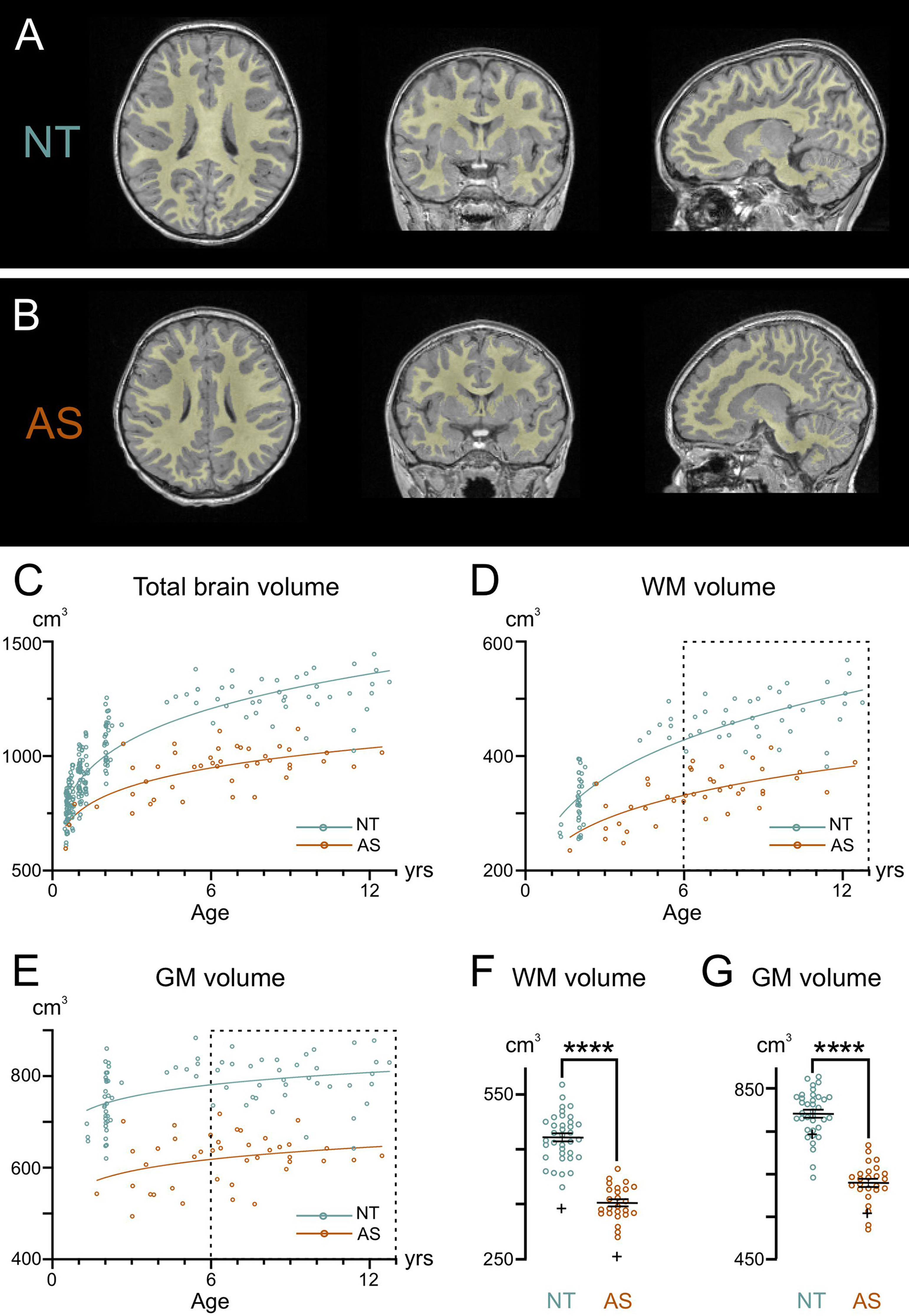 Comparative profiling of white matter development in the human and mouse brain reveals volumetric deficits and delayed myelination in Angelman syndrome