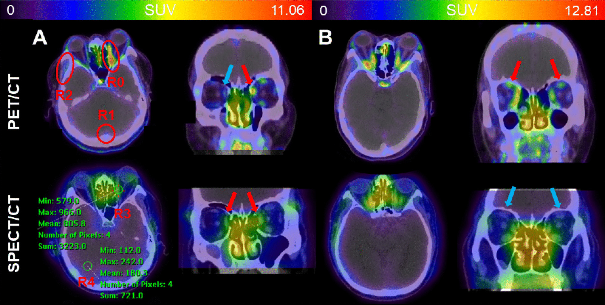 Evaluation of Inflammatory Activity of Extraocular Muscles in Thyroid Associated Orbitopathy by [68Ga]DOTATATE PET/CT