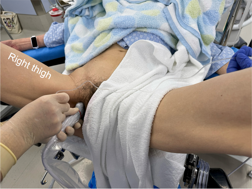 Ultrasound-guided obturator nerve block technique at the distal end of the obturator canal: case series and cadaver evaluation
