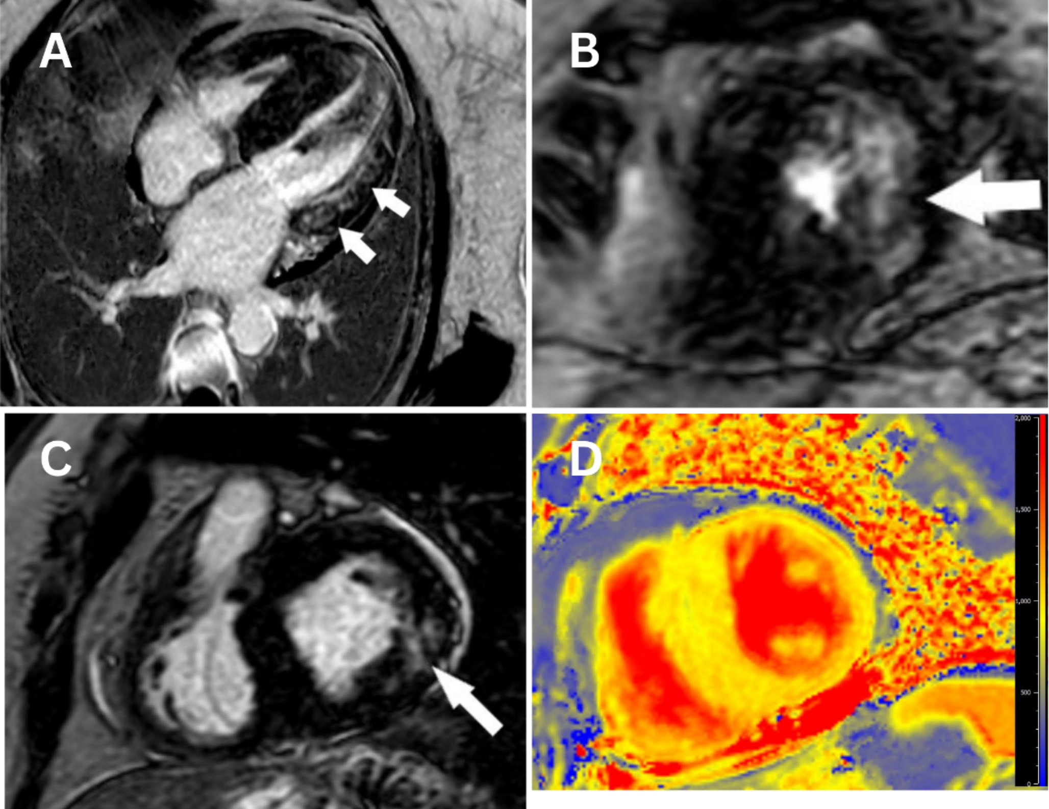 NASCI case of the month: “pseudo normalization of T1 values in Anderson-Fabry disease”