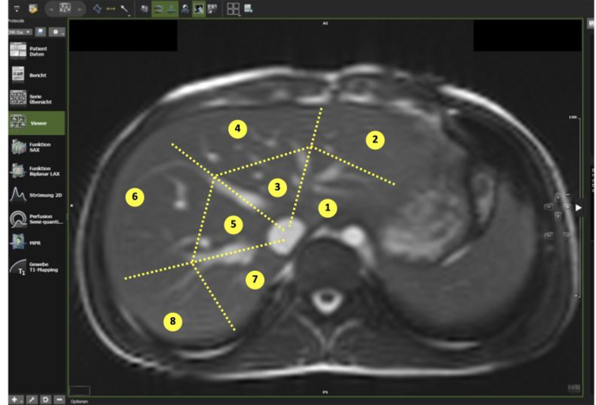 Liver T1 mapping in Fontan patients and patients with biventricular congenital heart disease – insights into the effects of venous congestions on diffuse liver disease