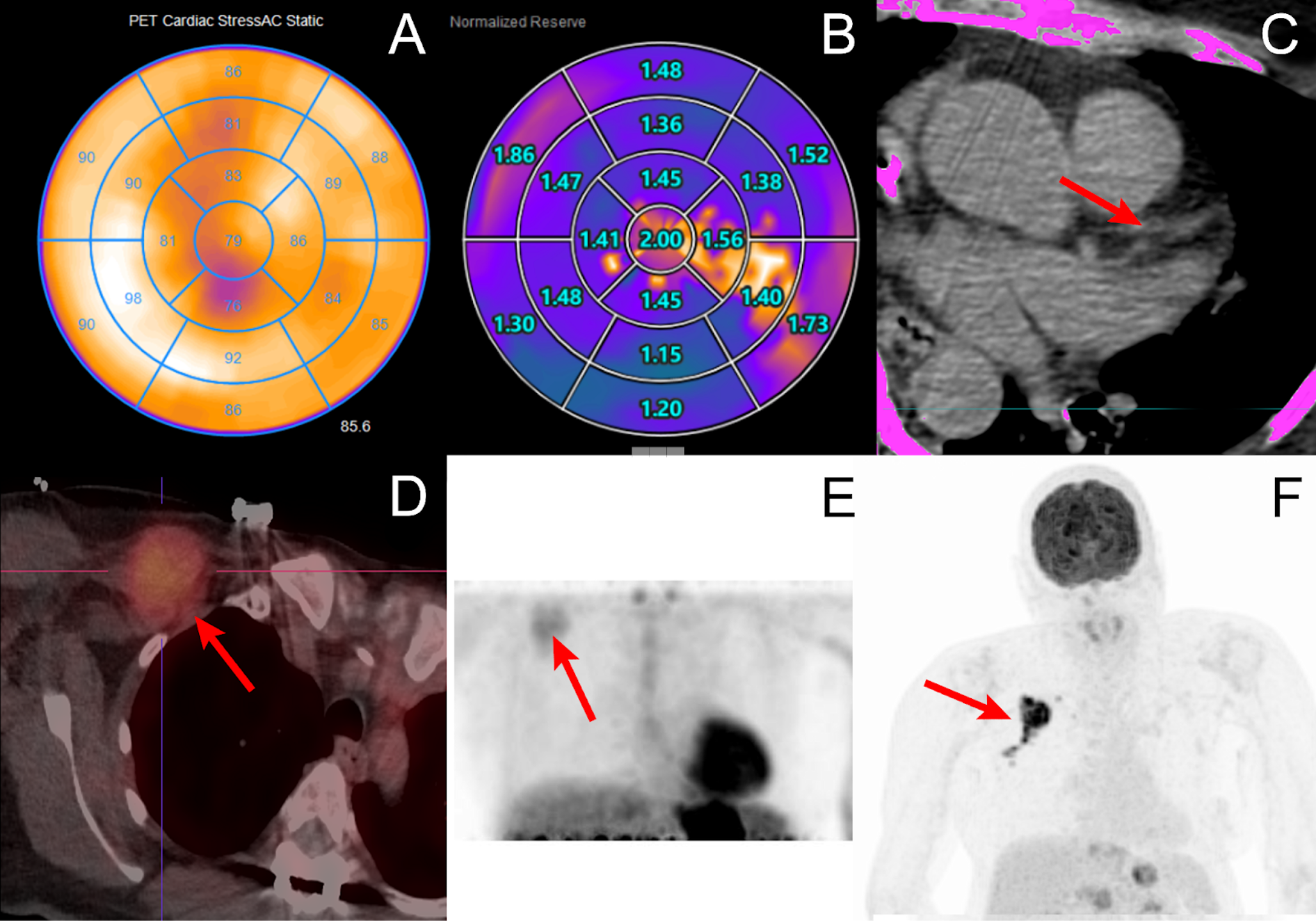 Cardiotoxicity as important differential diagnosis for reduced myocardial blood flow during Rubidium cardiac PET/CT