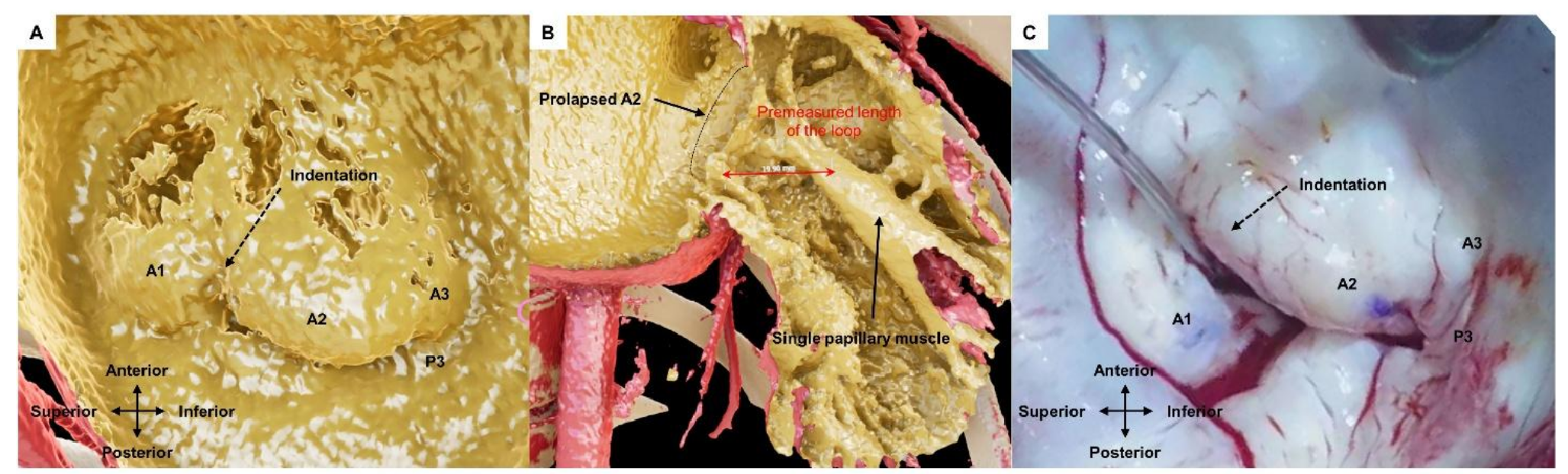 Visualization of complex mitral valve anatomy using real-time three-dimensional computer graphics