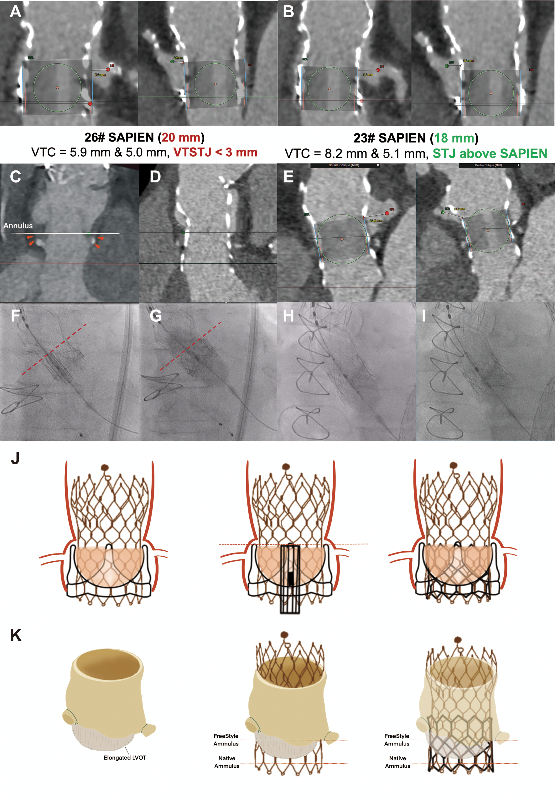 Role of imaging in third aortic valve implantation: TAV-in-TAV-in-SAV