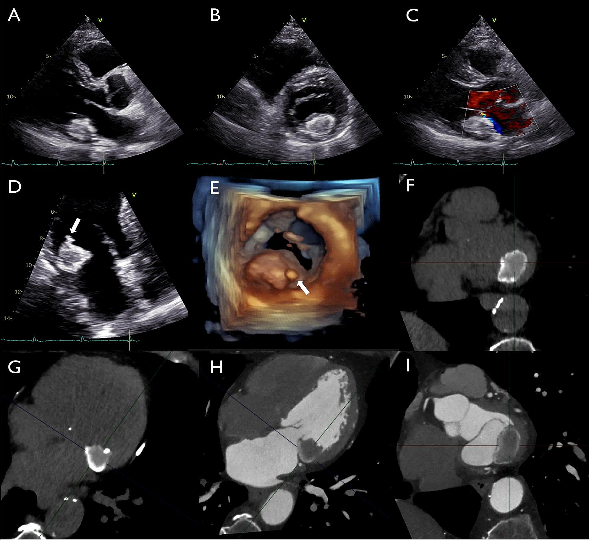 Multimodality imaging of caseous mitral annular calcification complicated by possible systemic embolizations