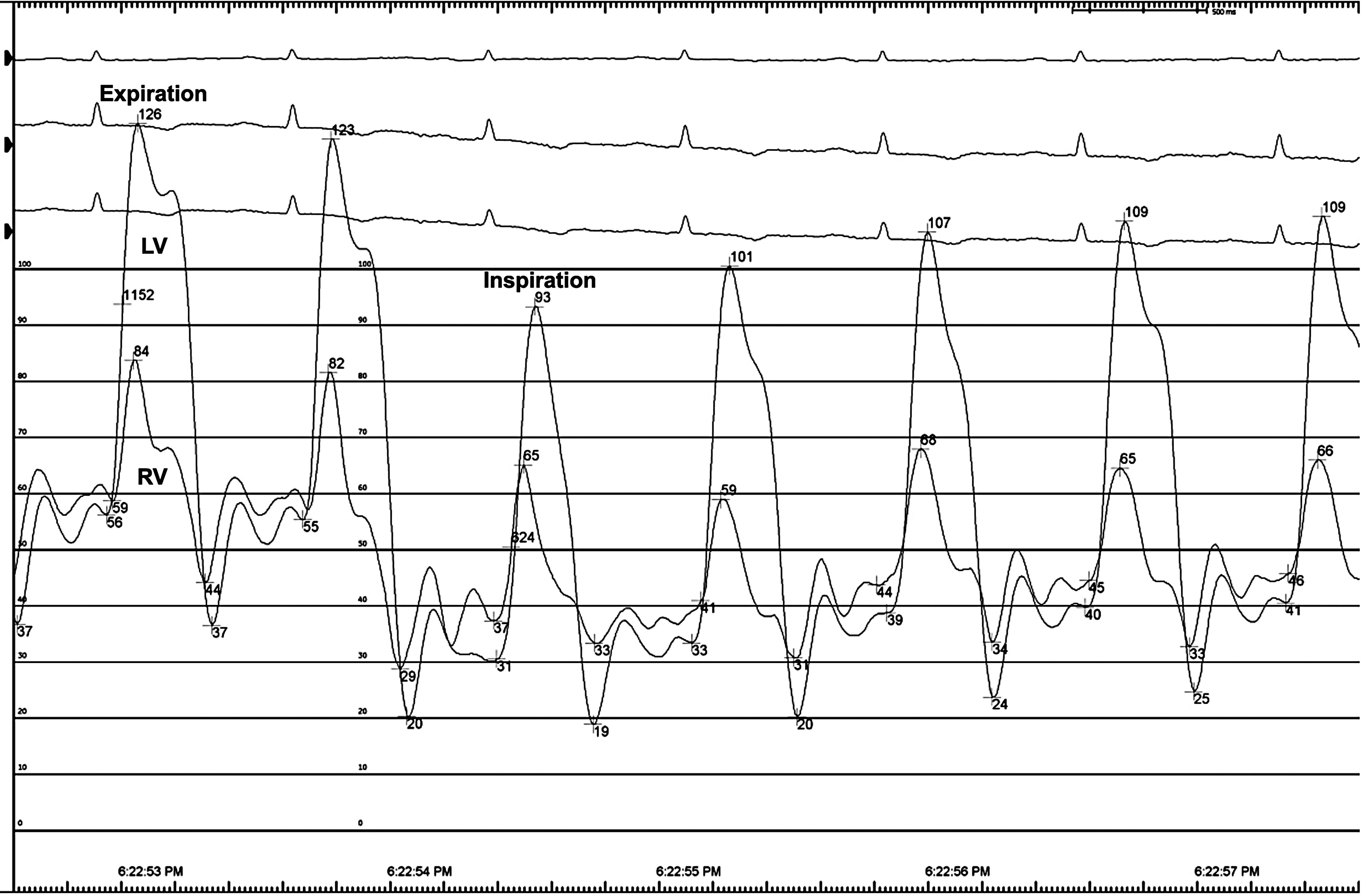 Overcoming diagnostic challenges in constrictive pericarditis: why volume is important?